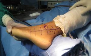 Операция на голеностопном суставе при переломе