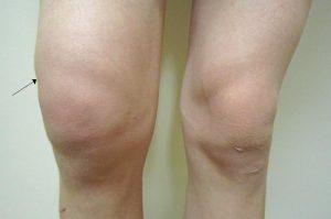 Отек - один из симптомов травмы колена