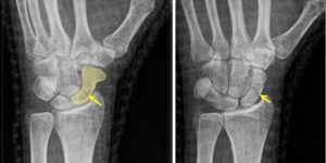 Рентген при переломе лучезапястного сустава