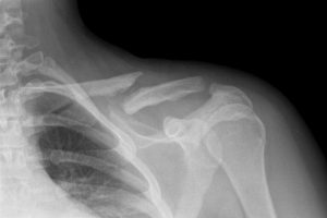 Рентгеновский снимок перелома ключицы