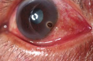 Основным признаком механического воздействия выступают нарушения зрения и кровоизлияния